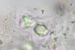 tinh thể calci oxalat